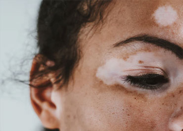 Vitiligo