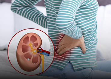 Kidney Stone