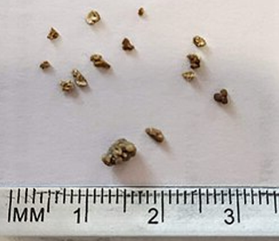 Kidney Stone