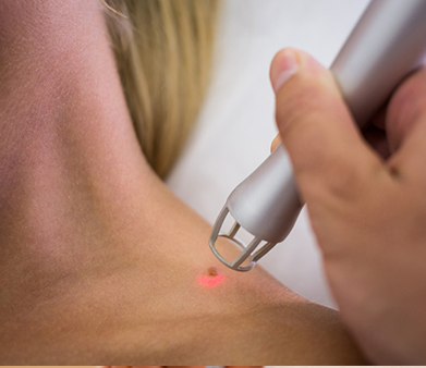 Wart Removal