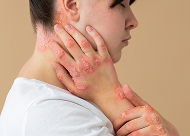 Atopic dermatitis