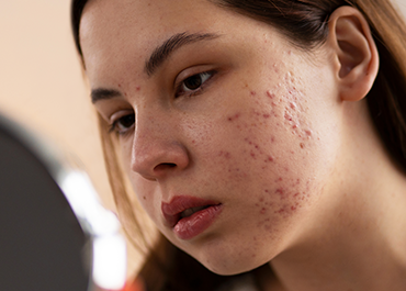 Pimple (Acne)