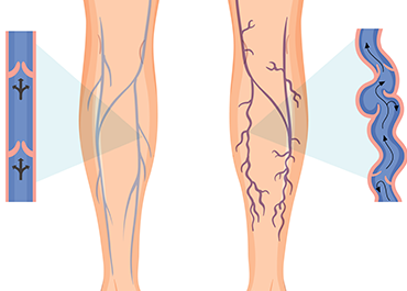 Varicose Ulcer