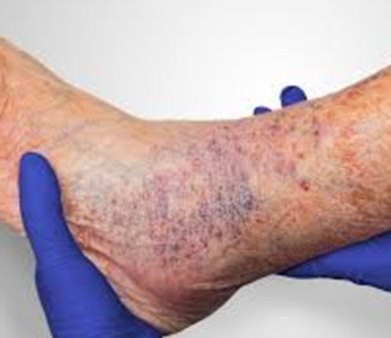 Varicose Ulcer
