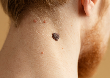 Warts