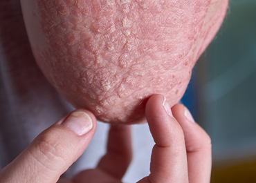 Psoriasis