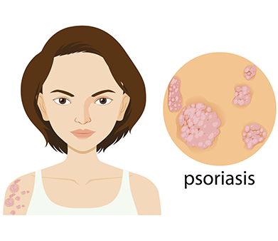 Psoriasis